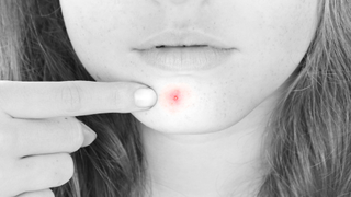 Forget the Pharmacy: Thyme Might Be Your Best Pimple Cure